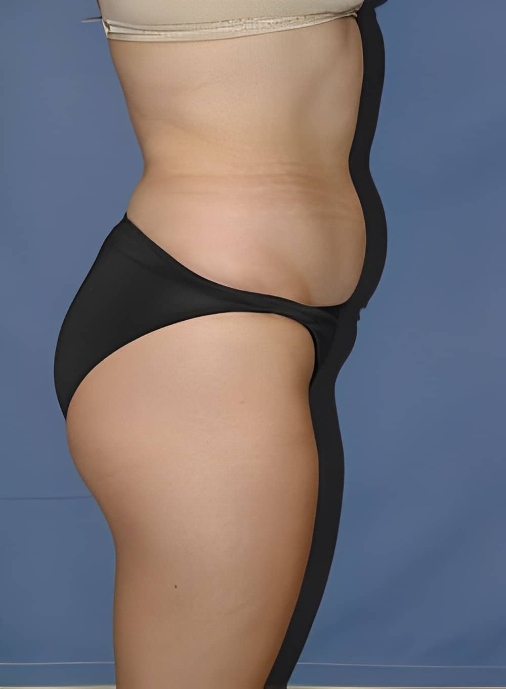 Before Image: Liposuction Back-Dr. Kenrick Spence - right-side