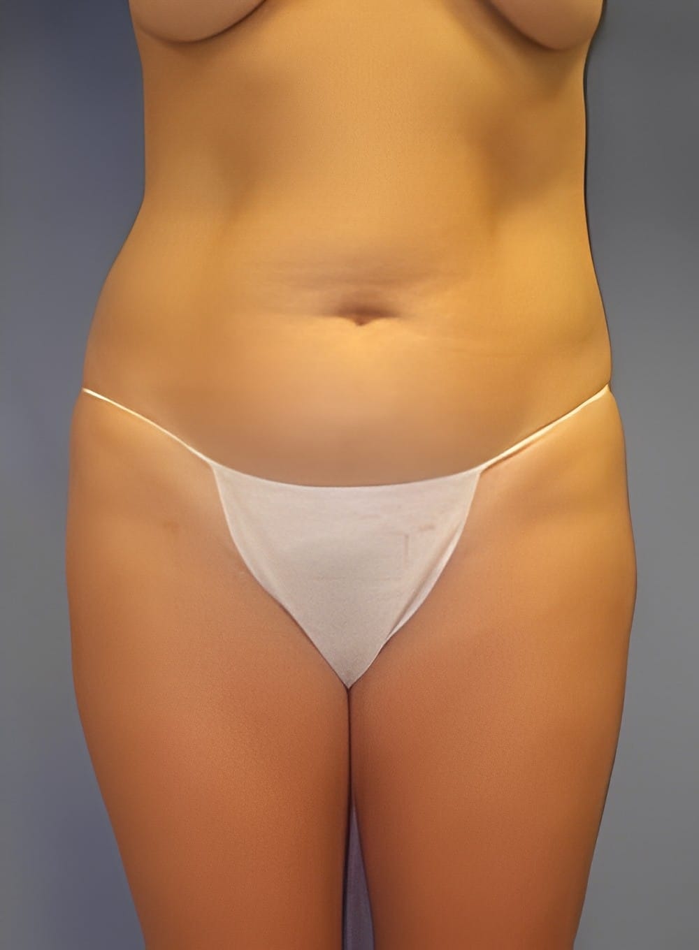 Before Image: Liposuction Back-Dr. Kenrick Spence - front