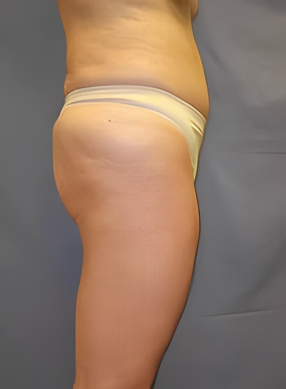 After Image: Liposuction Back-Dr. Kenrick Spence - right-side
