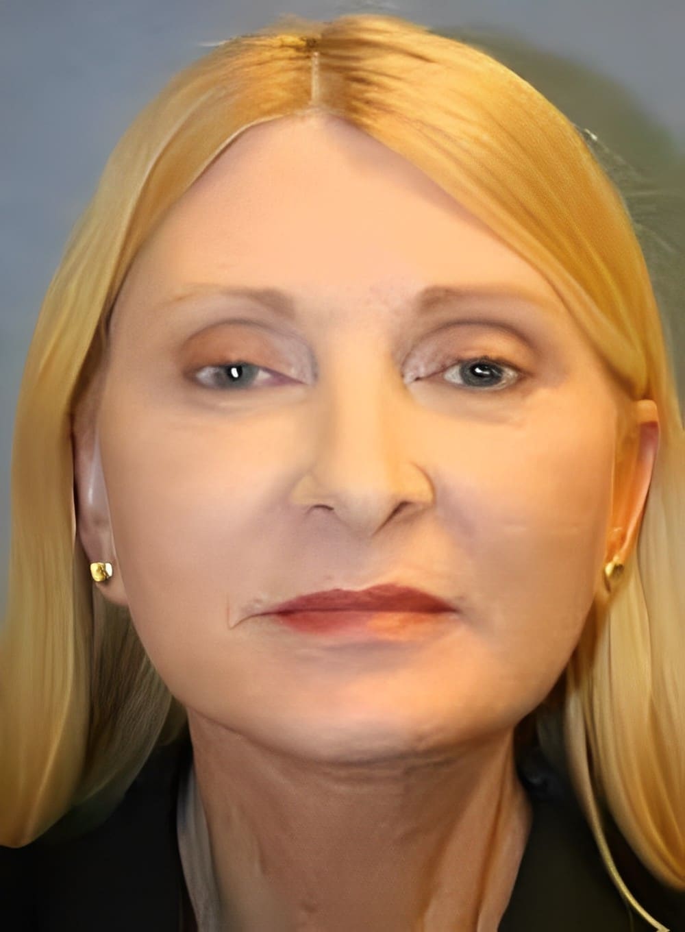 After Image: Liposuction Neck-Dr. Kenrick Spence - front