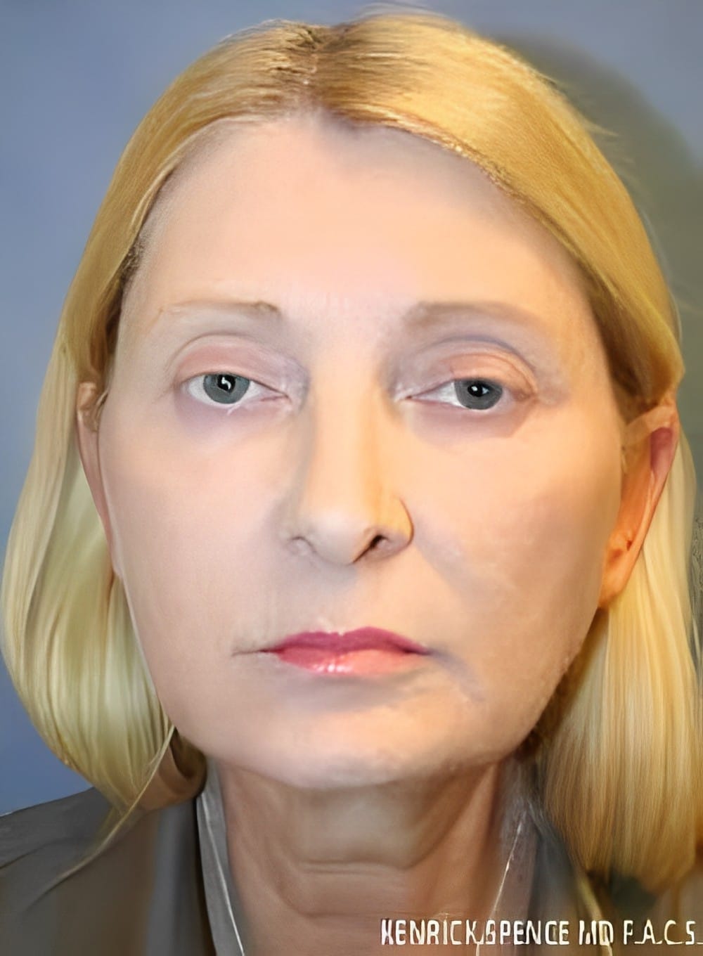 Before Image: Liposuction Neck-Dr. Kenrick Spence - front