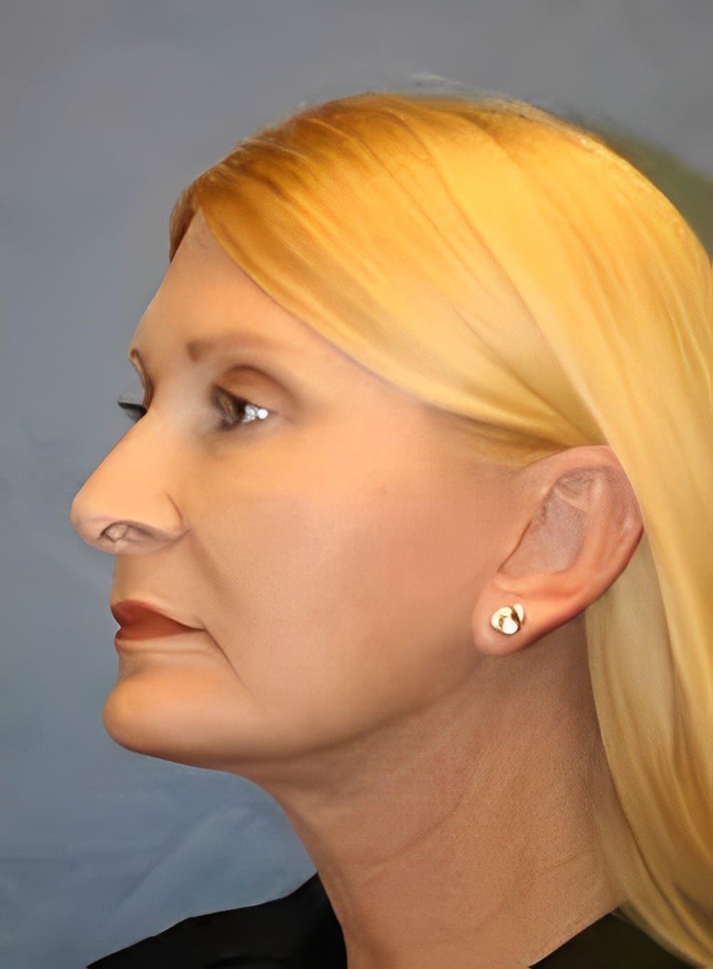 After Image: Liposuction Neck-Dr. Kenrick Spence - left-front-oblique
