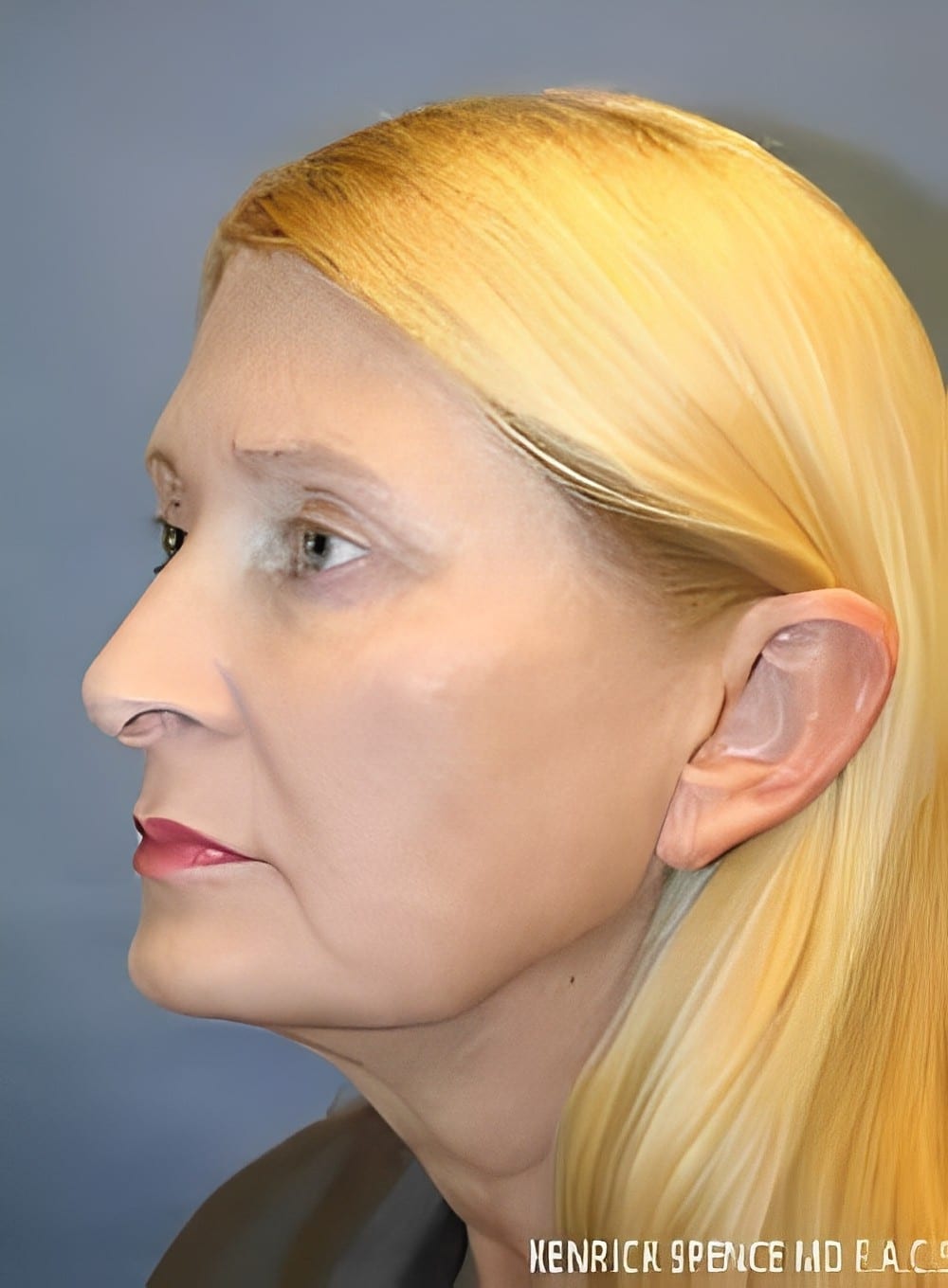 Before Image: Liposuction Neck-Dr. Kenrick Spence - left-front-oblique