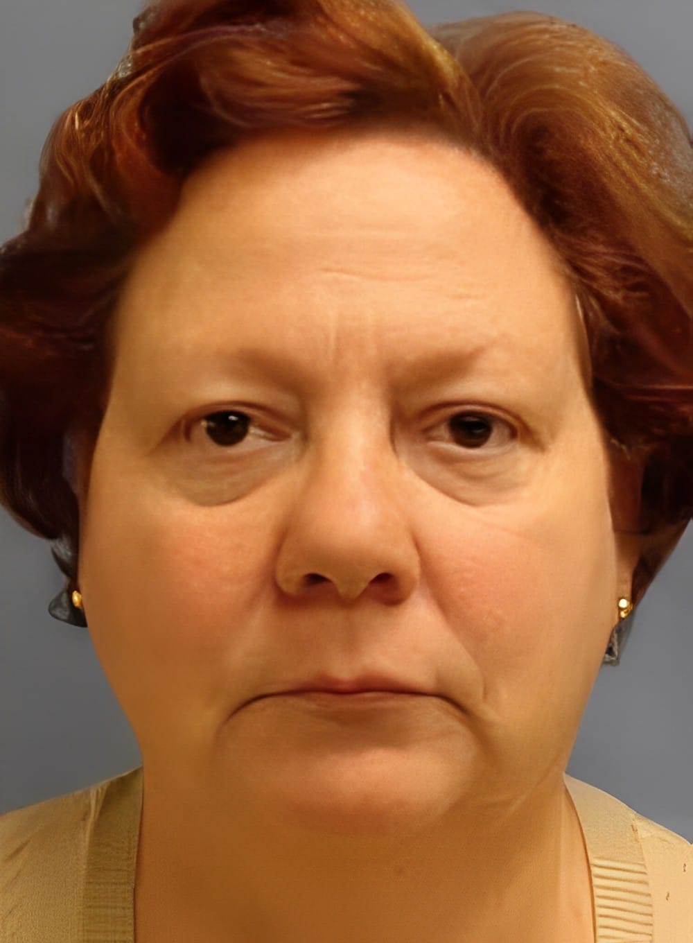 Before Image: Liposuction Neck-Dr. Kenrick Spence - front