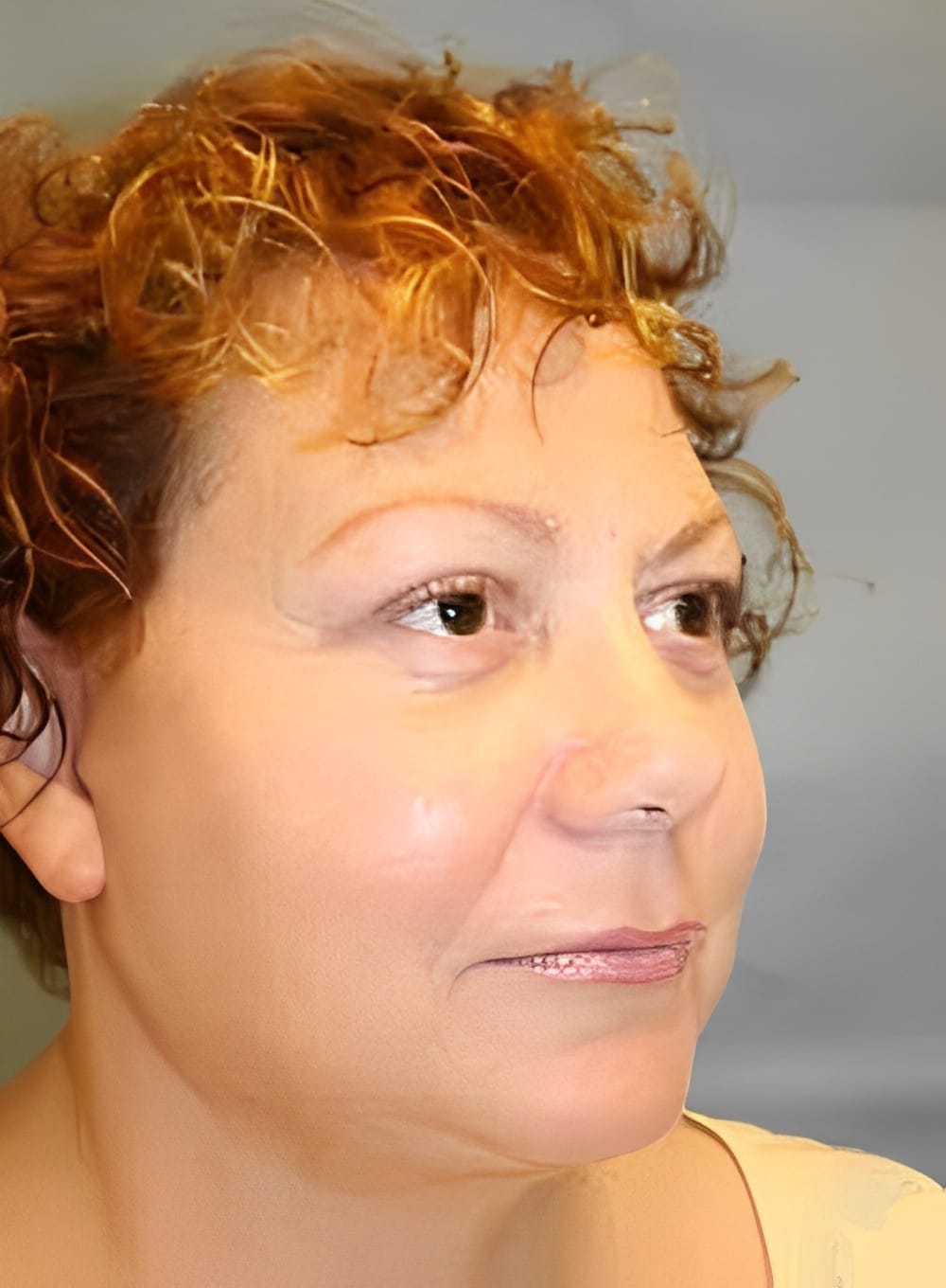 After Image: Liposuction Neck-Dr. Kenrick Spence - right-front-oblique