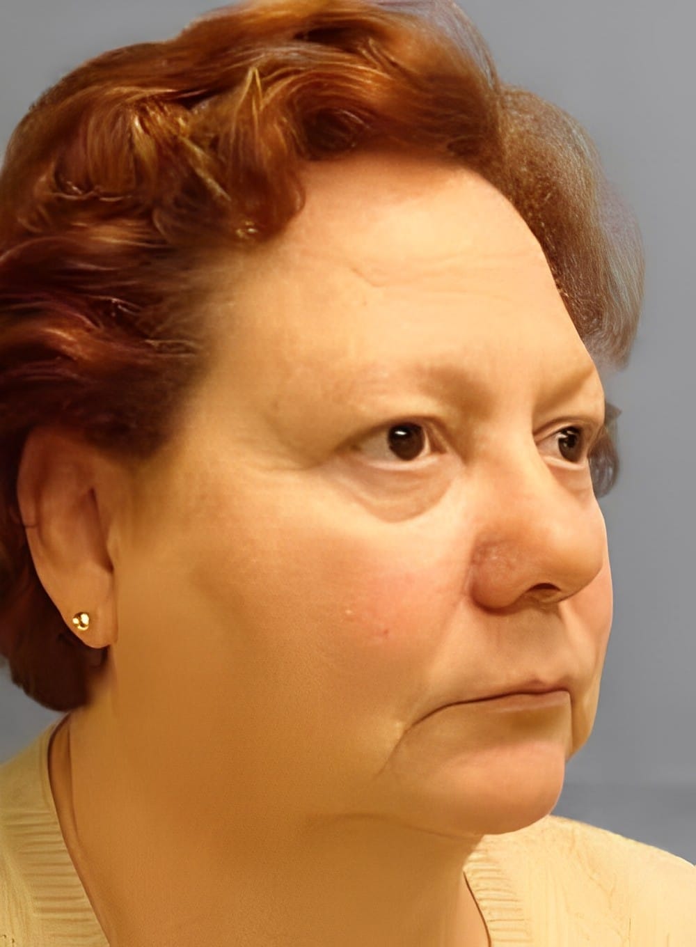 Before Image: Liposuction Neck-Dr. Kenrick Spence - right-front-oblique