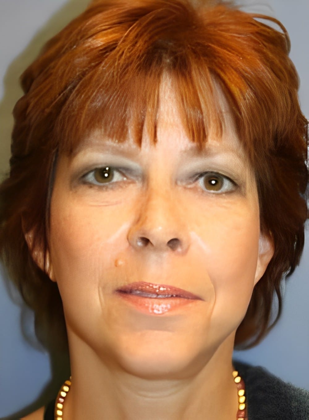 After Image: Liposuction Neck-Dr. Kenrick Spence - front