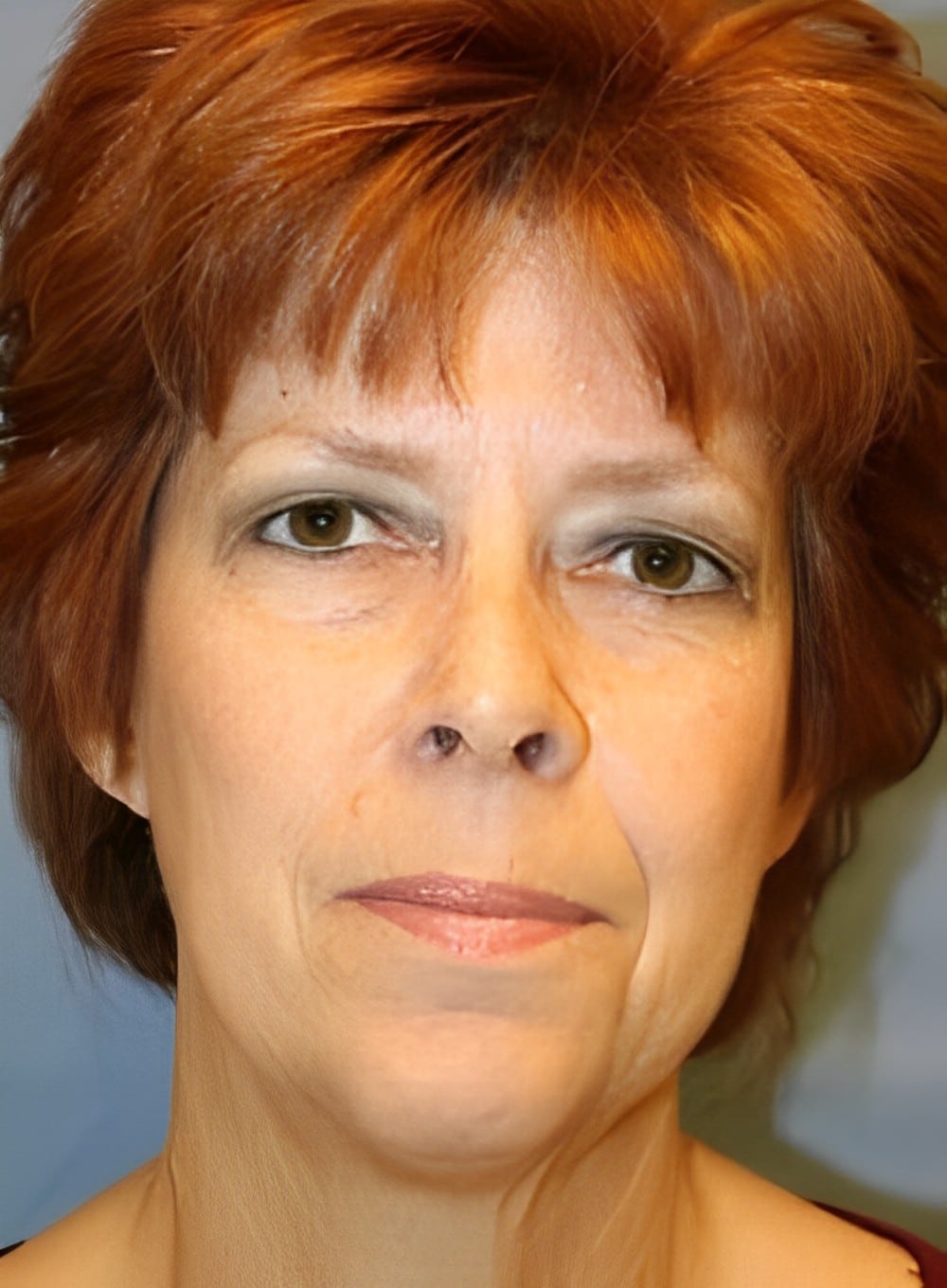 Before Image: Liposuction Neck-Dr. Kenrick Spence - front