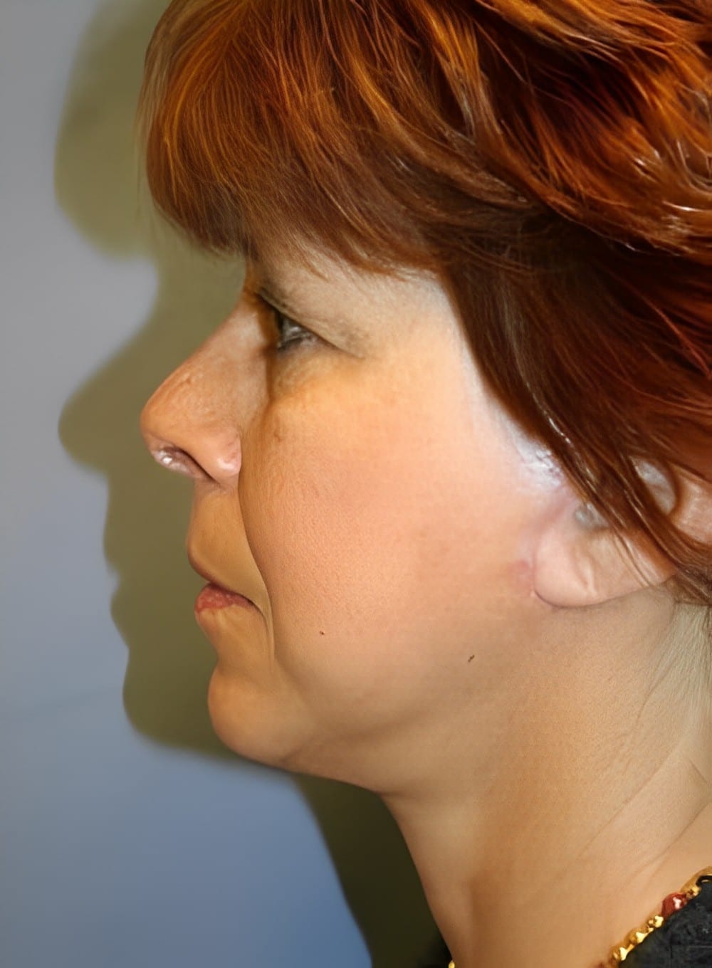 After Image: Liposuction Neck-Dr. Kenrick Spence - left-side