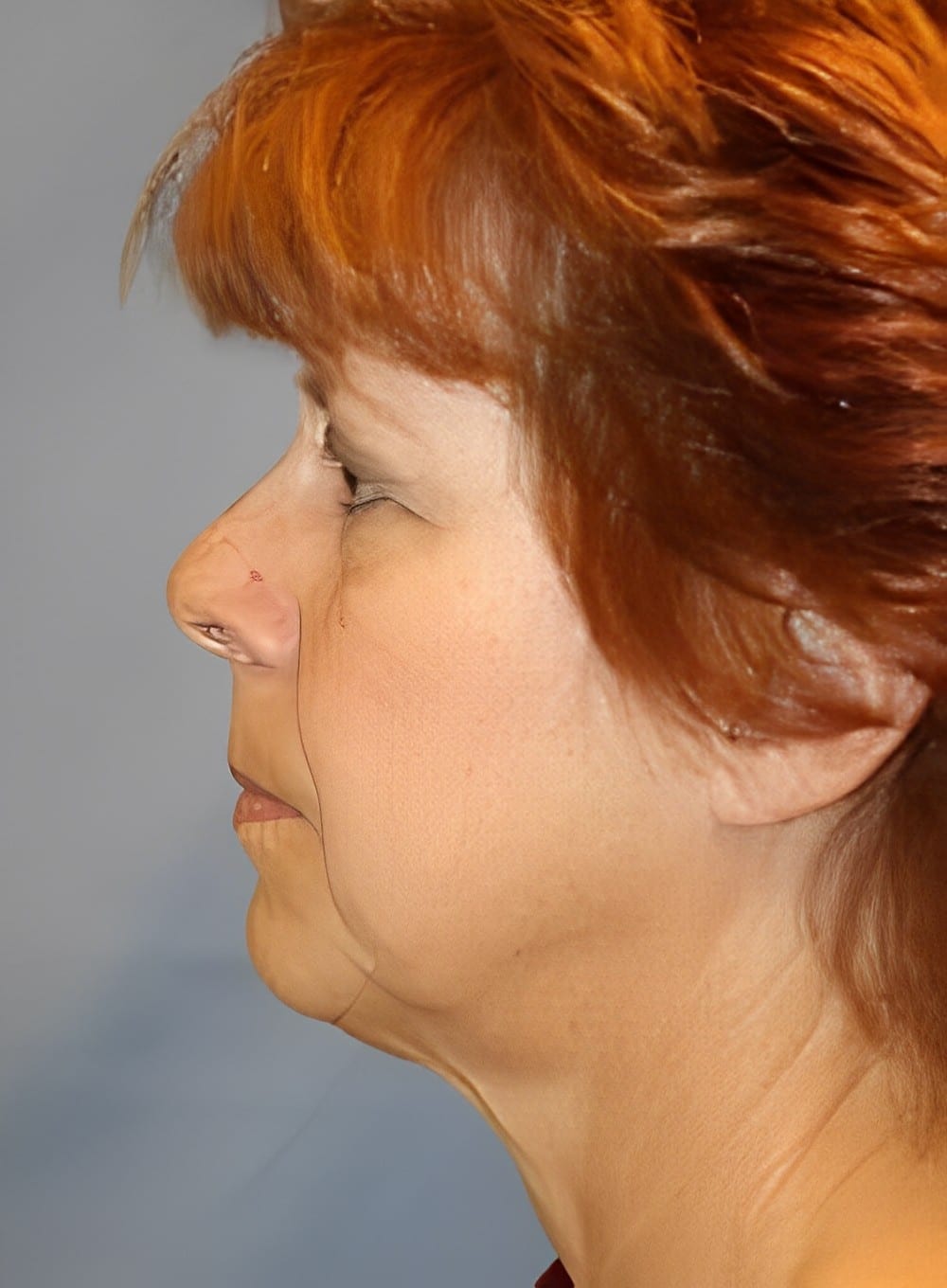 Before Image: Liposuction Neck-Dr. Kenrick Spence - left-side