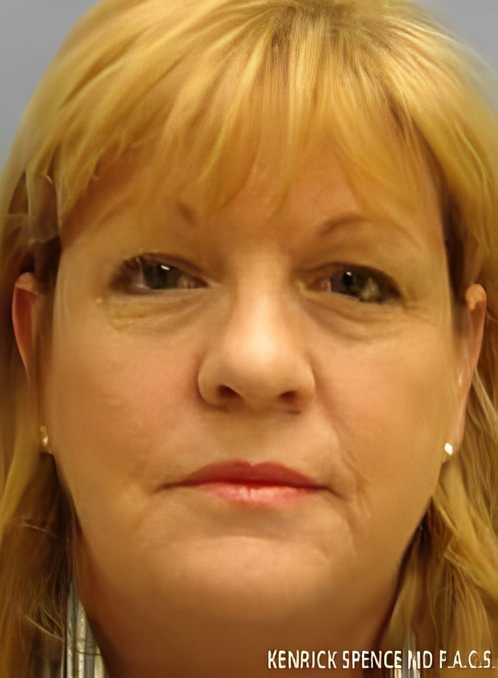 Before Image: Liposuction Neck-Dr. Kenrick Spence - front