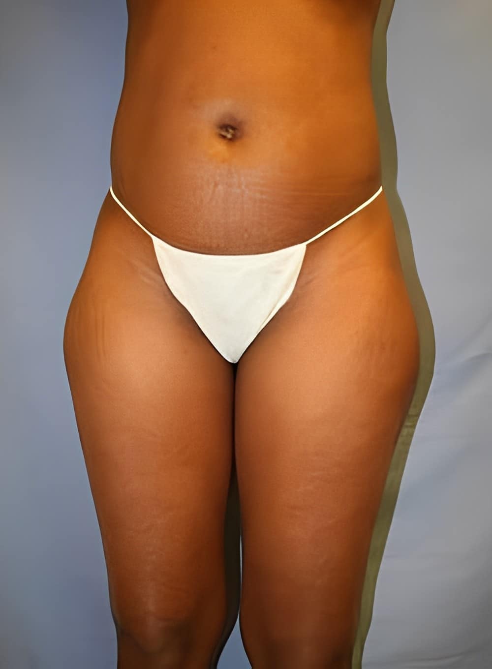 Before Image: Liposuction Saddlebags and Thighs-Dr. Kenrick Spence - front