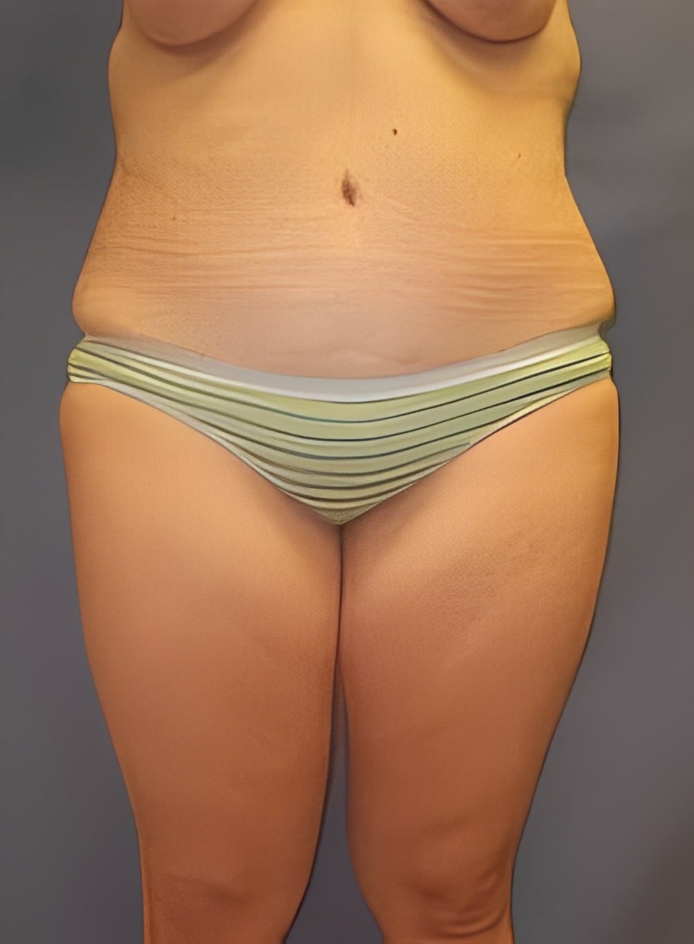 Before Image: Liposuction Saddlebags and Thighs-Dr. Kenrick Spence - front