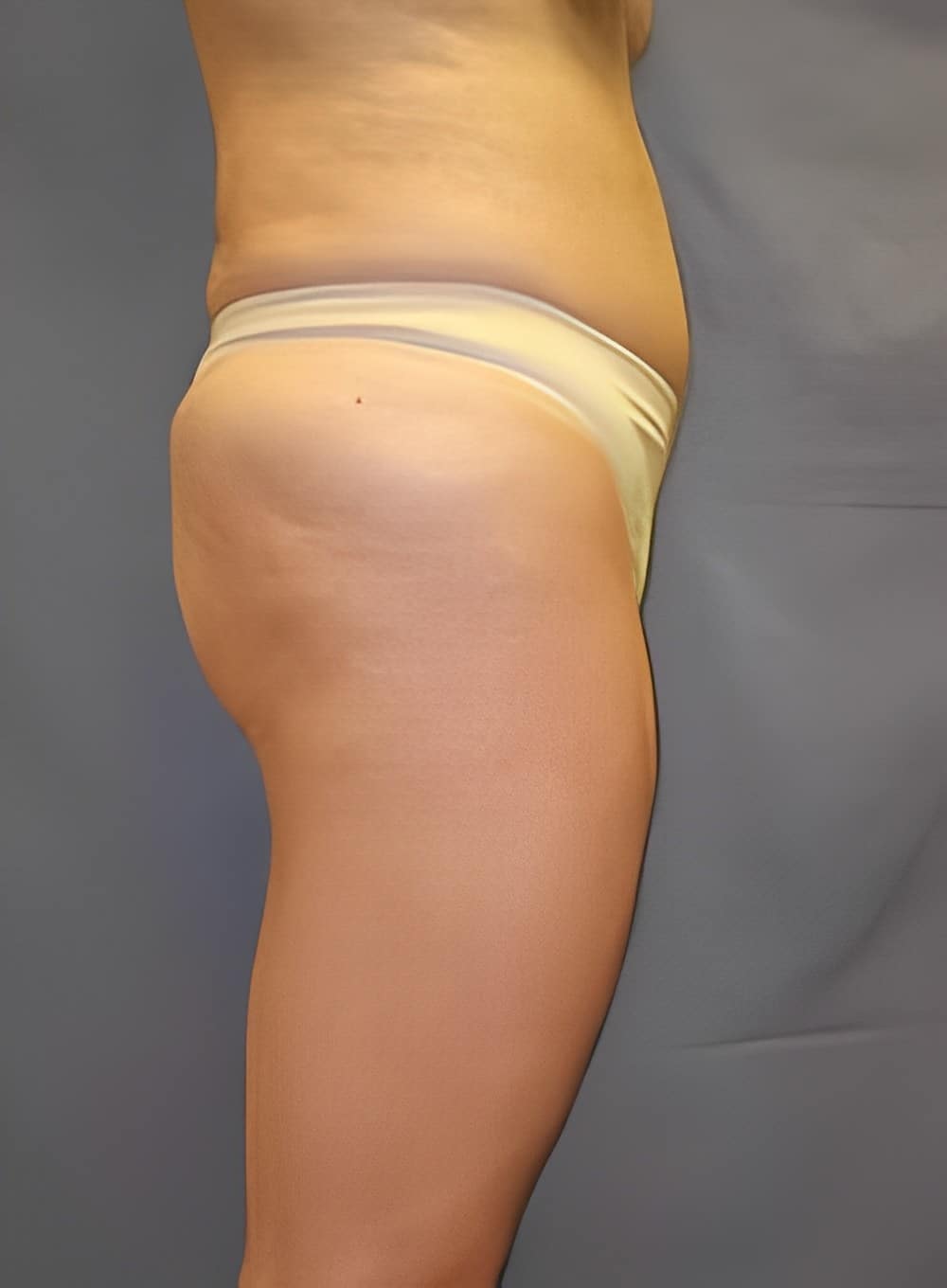 After Image: Liposuction Saddlebags and Thighs-Dr. Kenrick Spence - right-side
