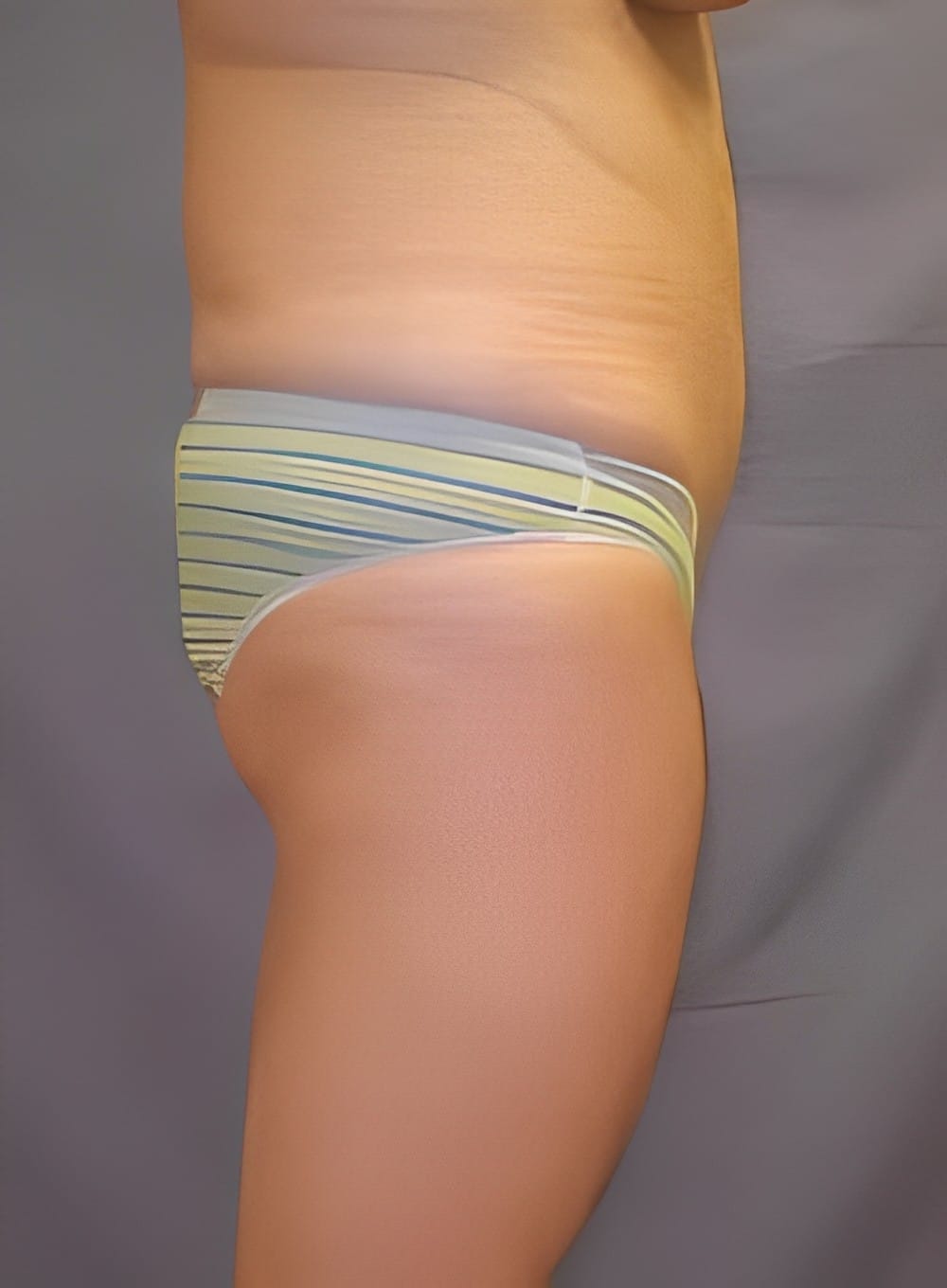 Before Image: Liposuction Saddlebags and Thighs-Dr. Kenrick Spence - right-side