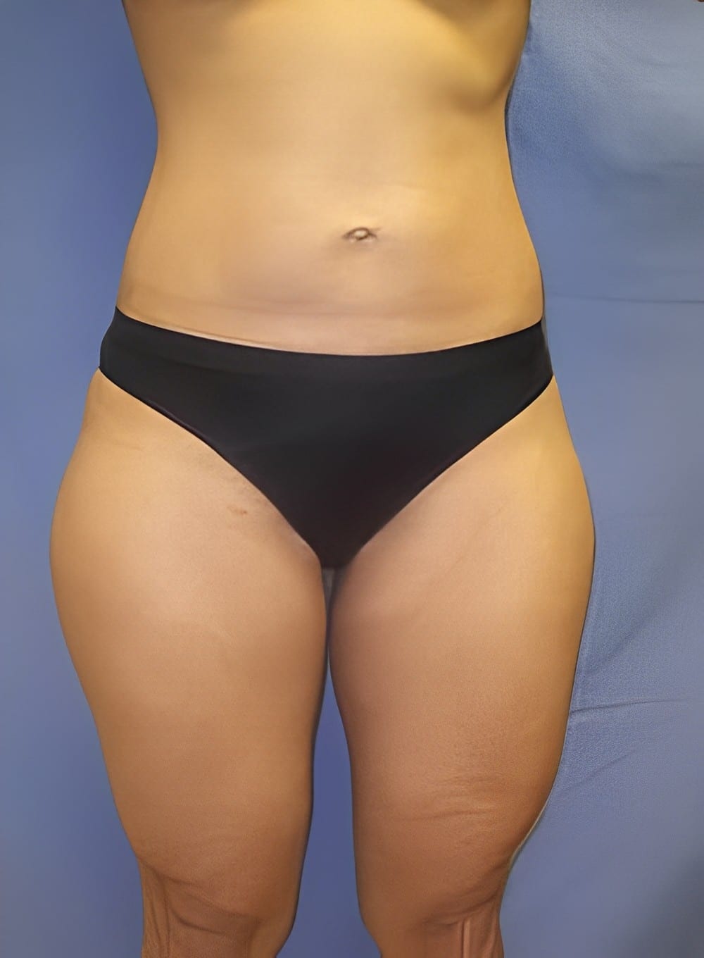 Before Image: Liposuction Saddlebags and Thighs-Dr. Kenrick Spence - front