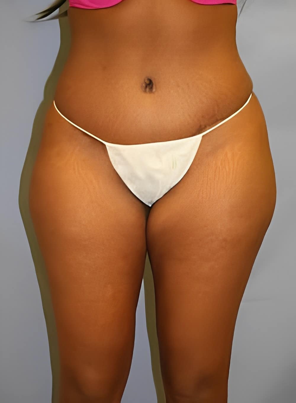 After Image: Liposuction Saddlebags and Thighs-Dr. Kenrick Spence - front