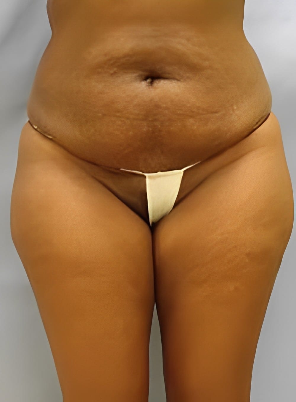 Before Image: Liposuction Saddlebags and Thighs-Dr. Kenrick Spence - front