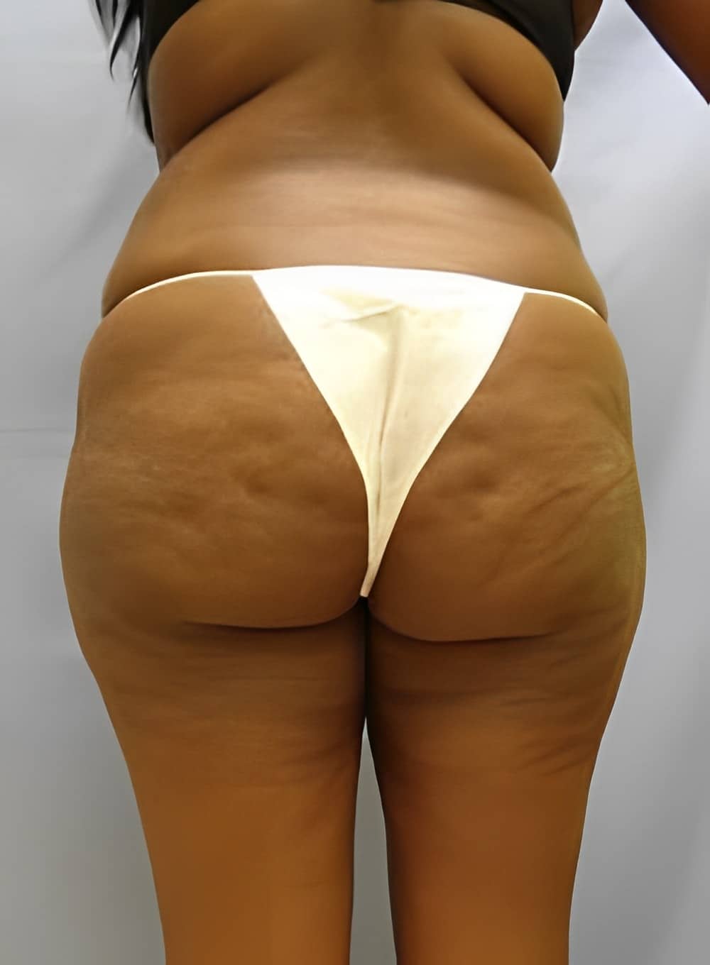 Before Image: Liposuction Saddlebags and Thighs-Dr. Kenrick Spence - back