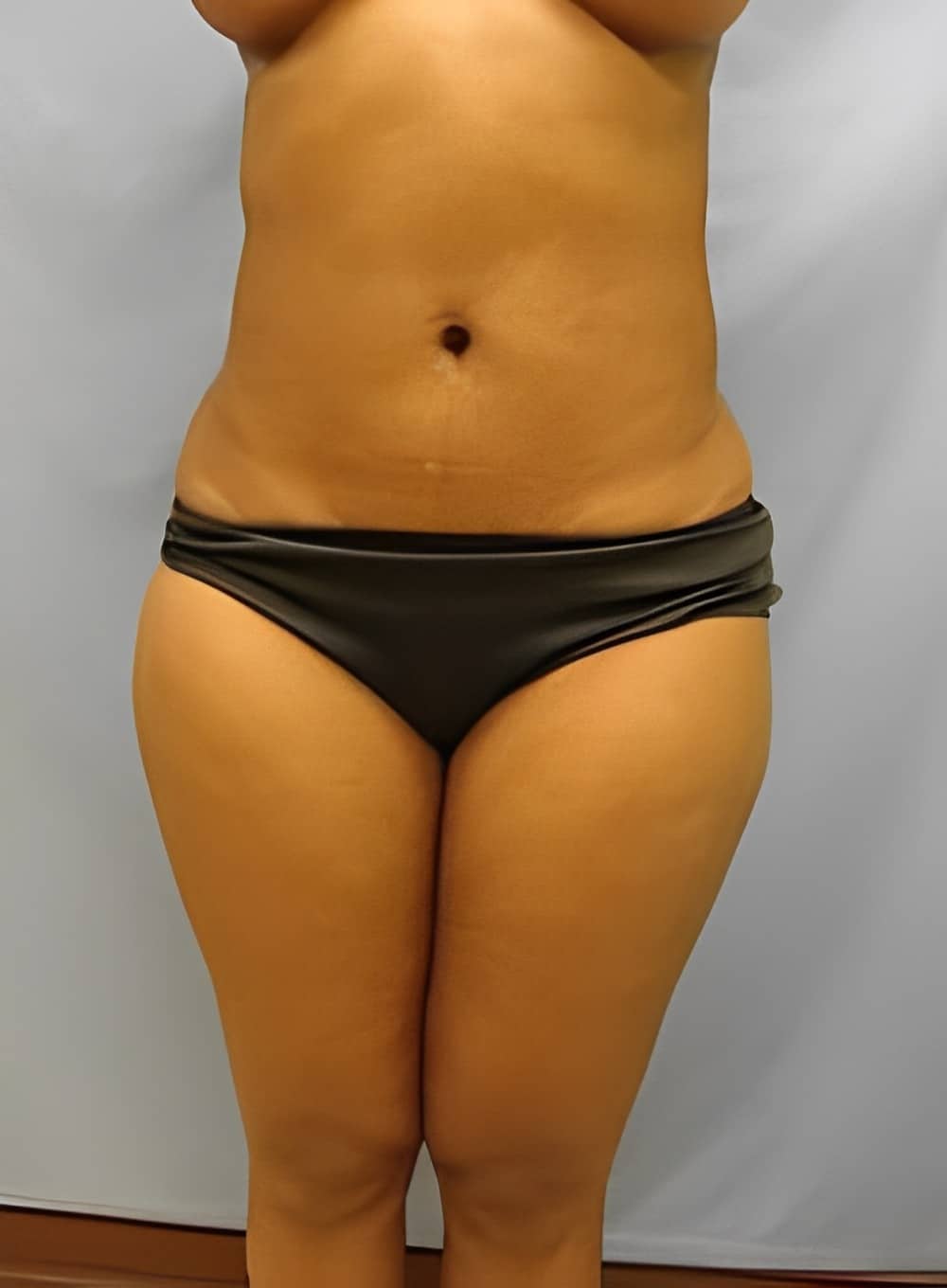 After Image: Liposuction Saddlebags and Thighs-Dr. Kenrick Spence - front