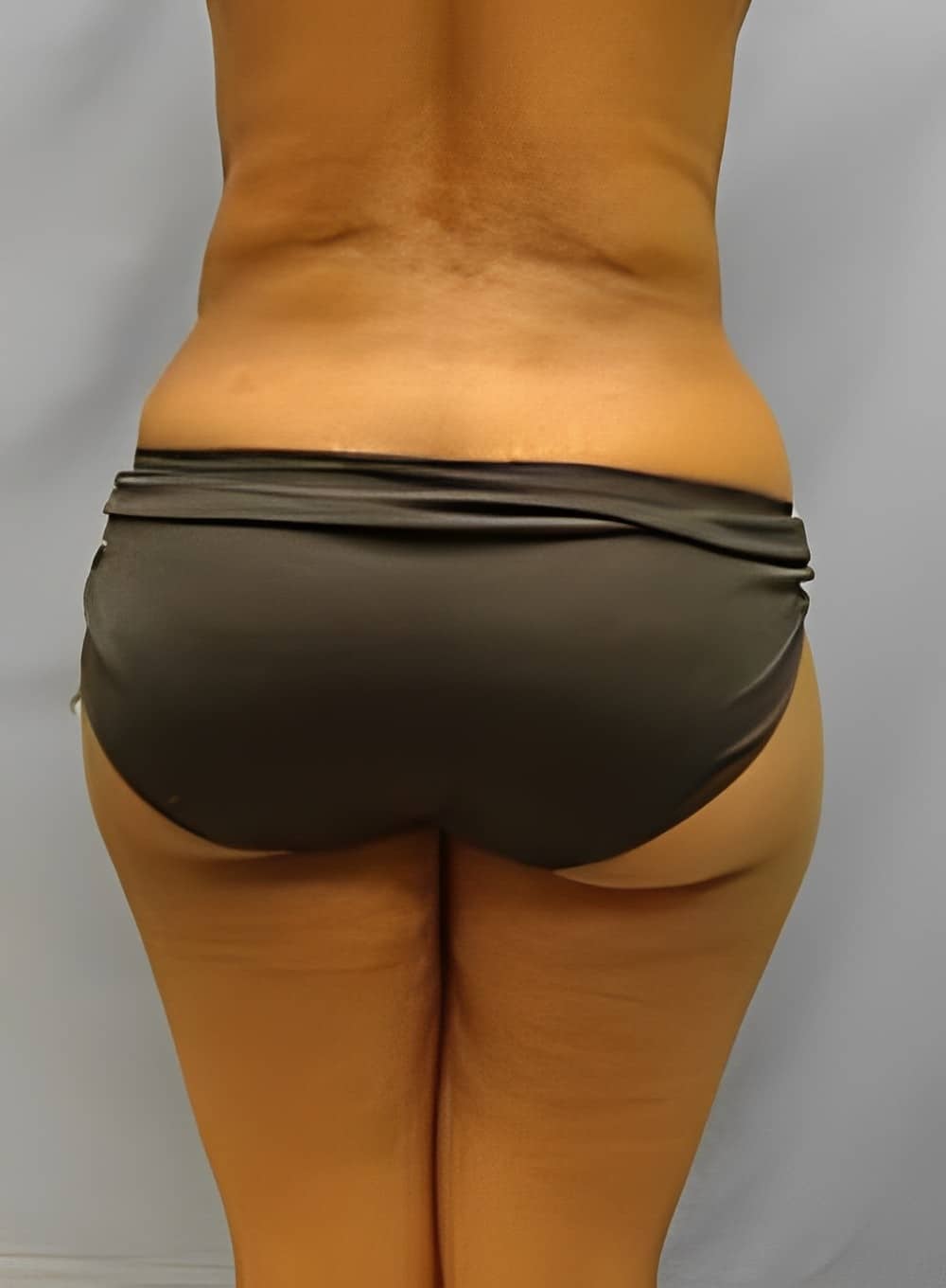 After Image: Liposuction Saddlebags and Thighs-Dr. Kenrick Spence - back