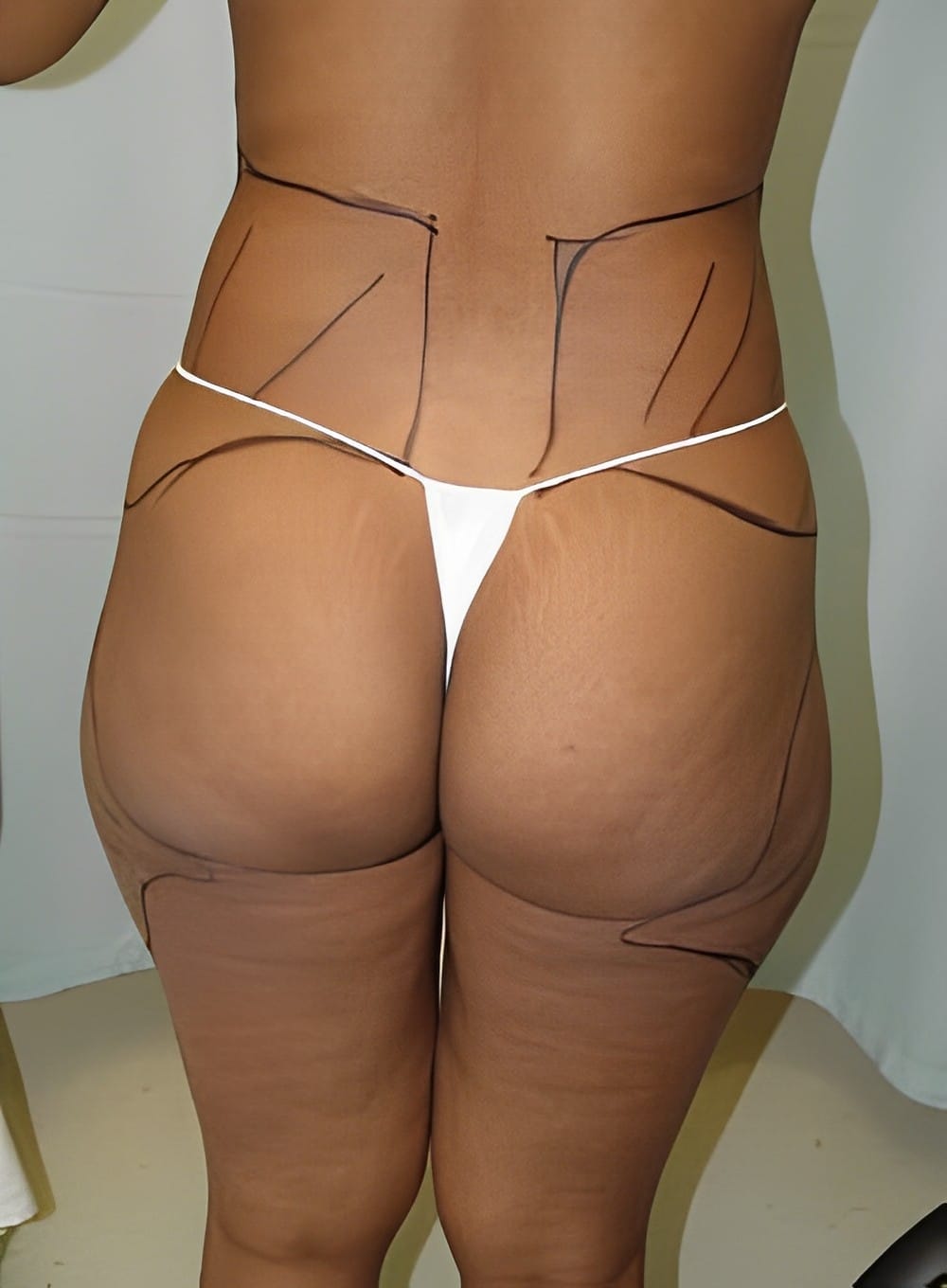 Before Image: Liposuction Saddlebags and Thighs-Dr. Kenrick Spence - back