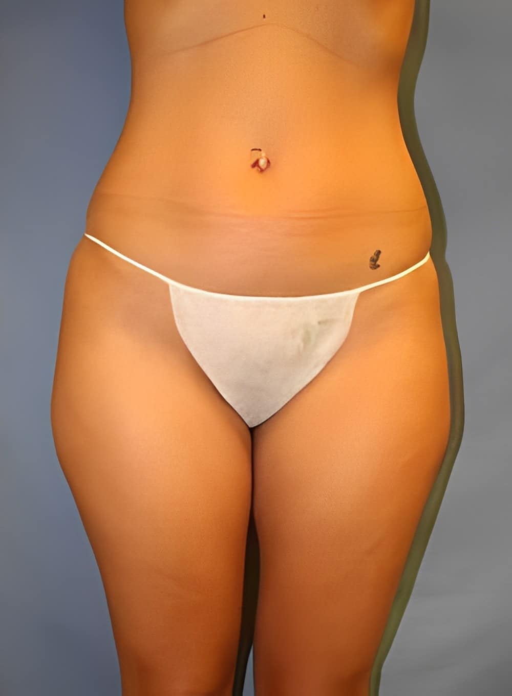 Before Image: Liposuction Saddlebags and Thighs-Dr. Kenrick Spence - front