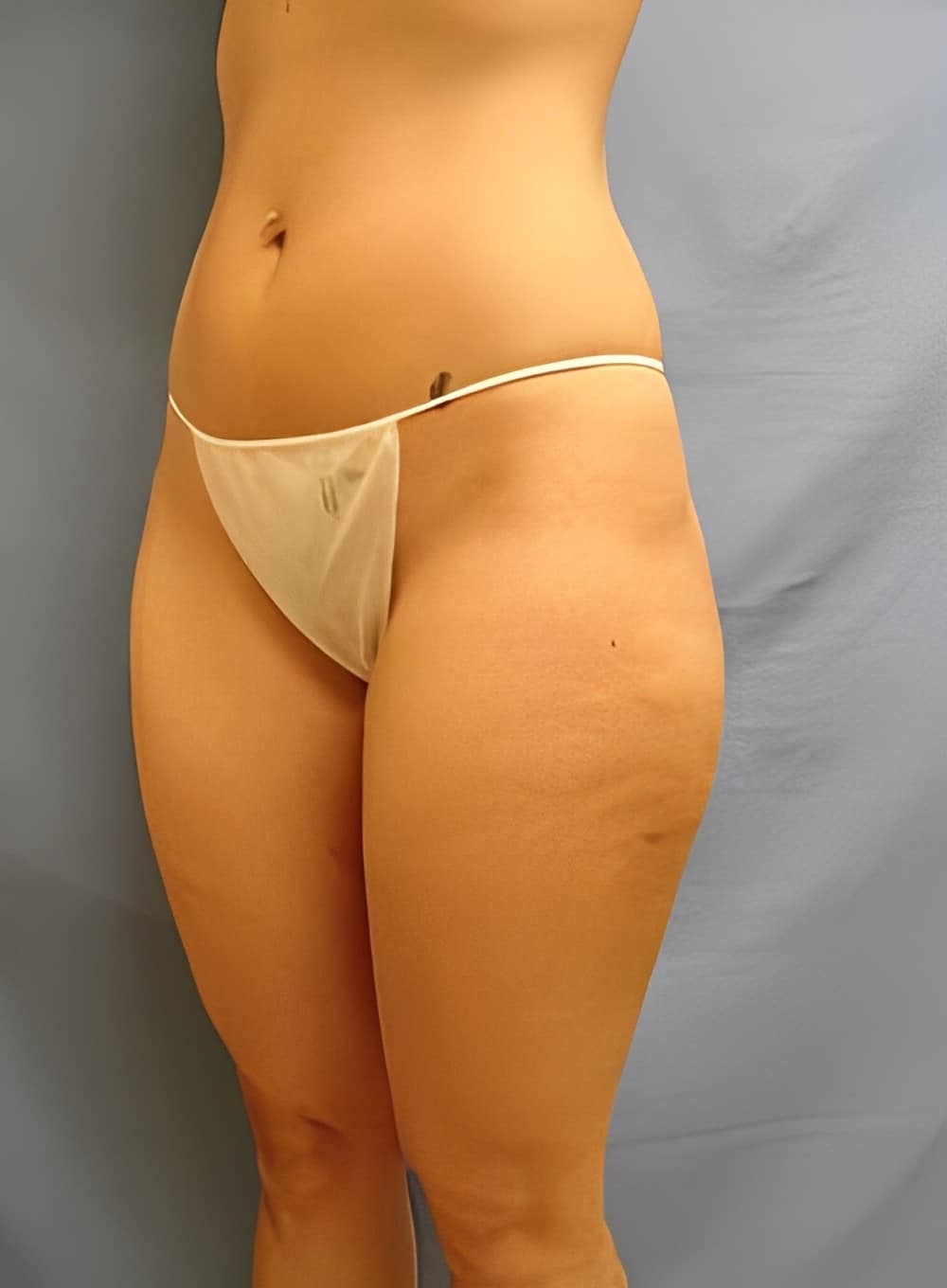After Image: Liposuction Saddlebags and Thighs-Dr. Kenrick Spence - left-front-oblique