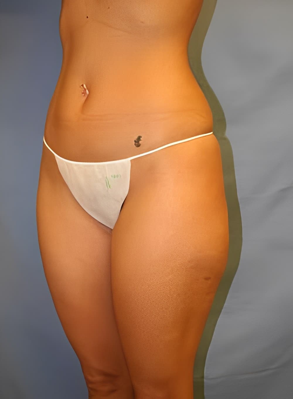 Before Image: Liposuction Saddlebags and Thighs-Dr. Kenrick Spence - left-front-oblique