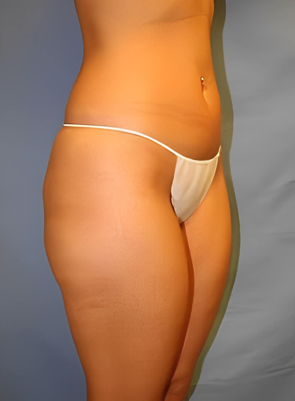 Before Image: Liposuction Saddlebags and Thighs-Dr. Kenrick Spence - right-front-oblique