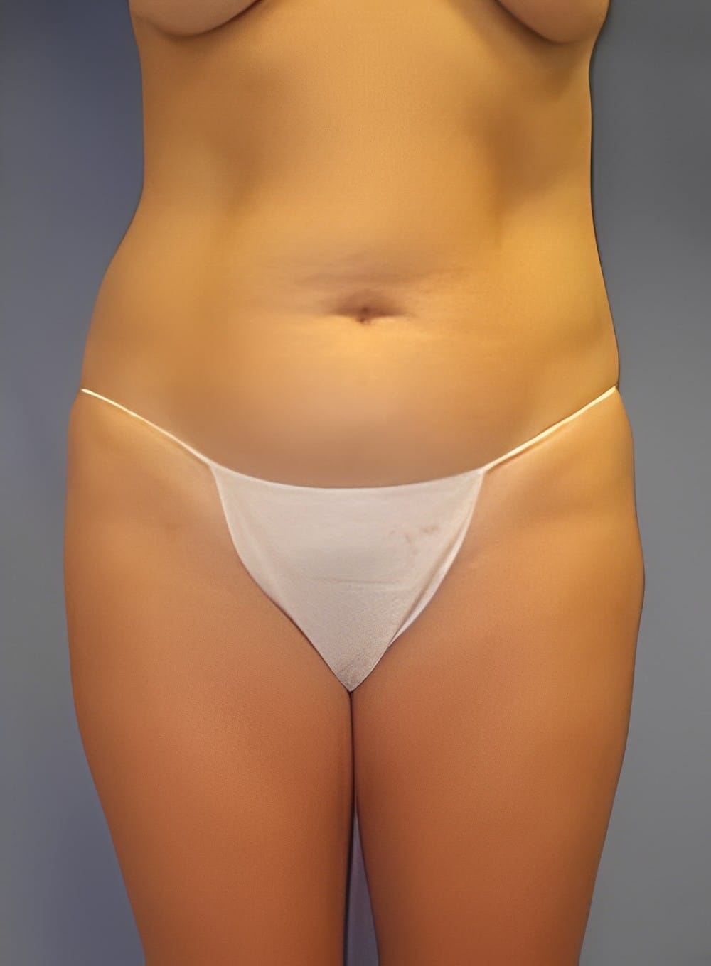 Before Image: Liposuction Saddlebags and Thighs-Dr. Kenrick Spence - front