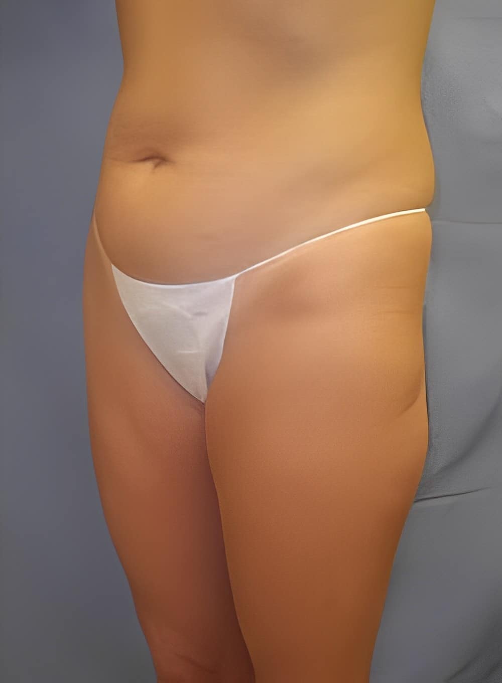 Before Image: Liposuction Saddlebags and Thighs-Dr. Kenrick Spence - left-front-oblique