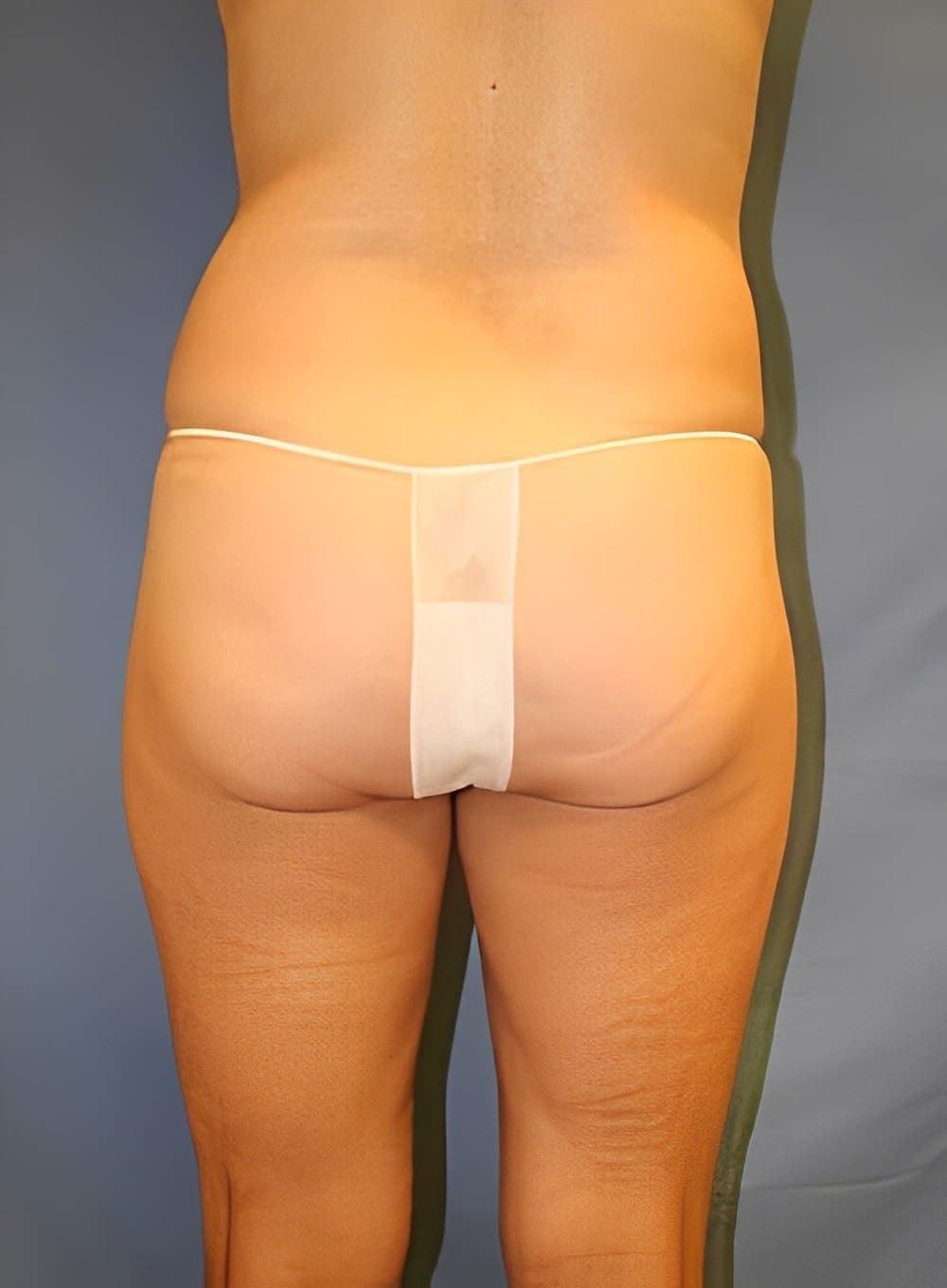 Before Image: Liposuction Saddlebags and Thighs-Dr. Kenrick Spence - back