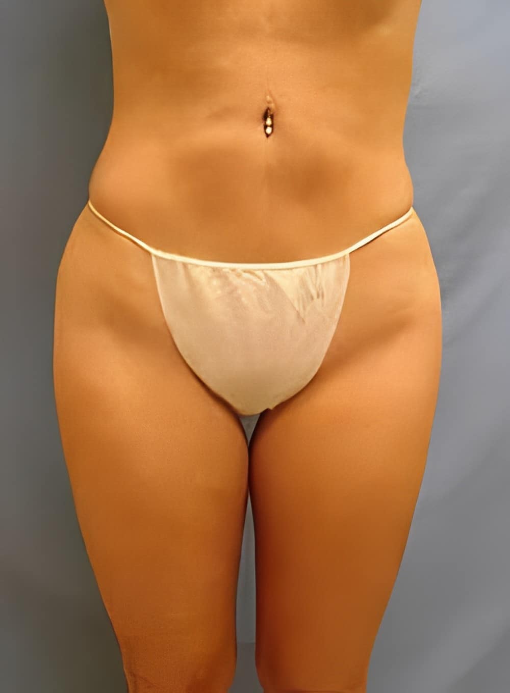 After Image: Tumescent Liposuction-Dr. Kenrick Spence - front