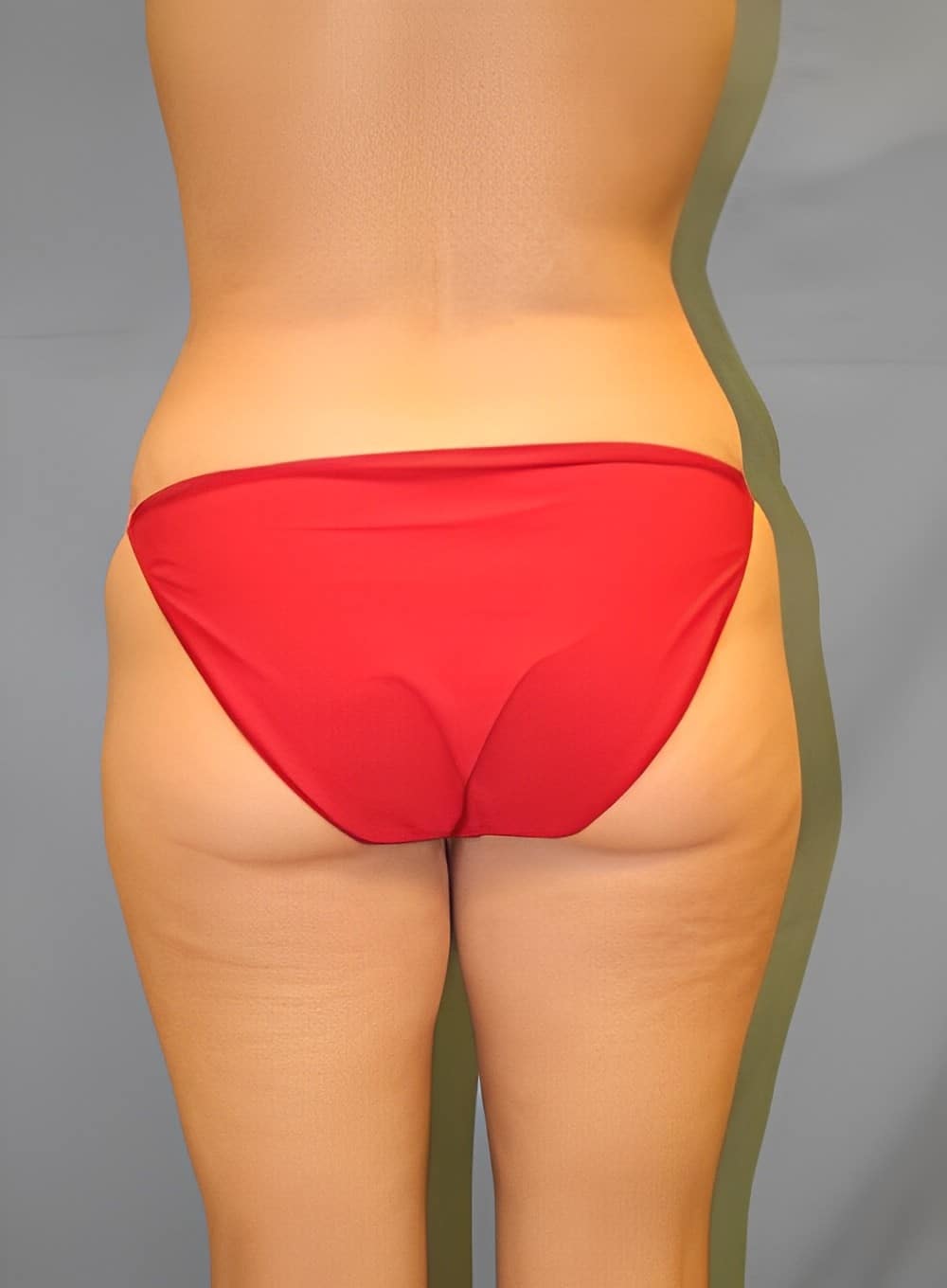 Before Image: Tumescent Liposuction-Dr. Kenrick Spence - back