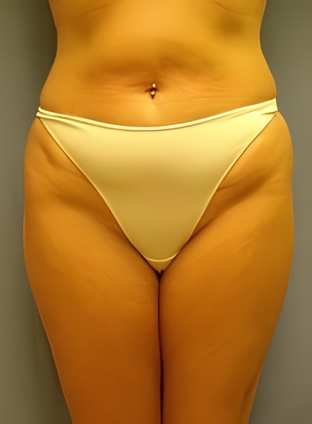 Before Image: Tumescent Liposuction-Dr. Kenrick Spence - front