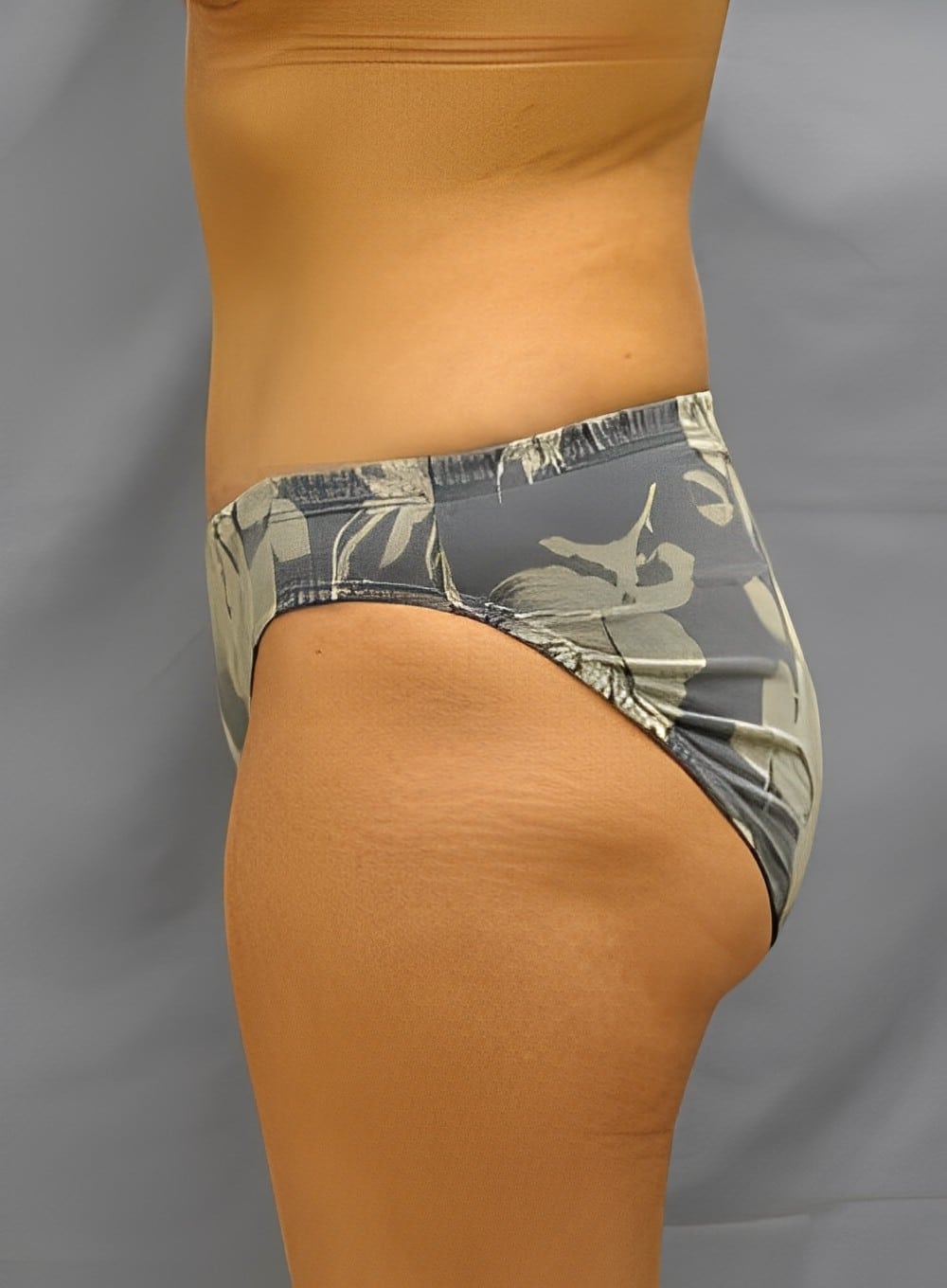 After Image: Tumescent Liposuction-Dr. Kenrick Spence - left-side