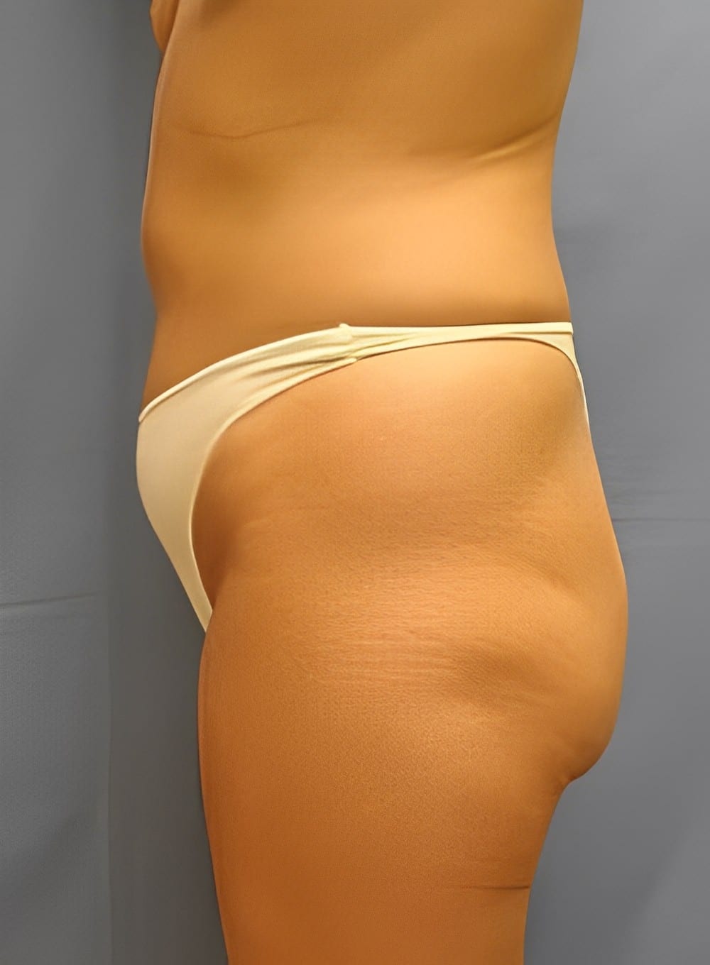 Before Image: Tumescent Liposuction-Dr. Kenrick Spence - left-side