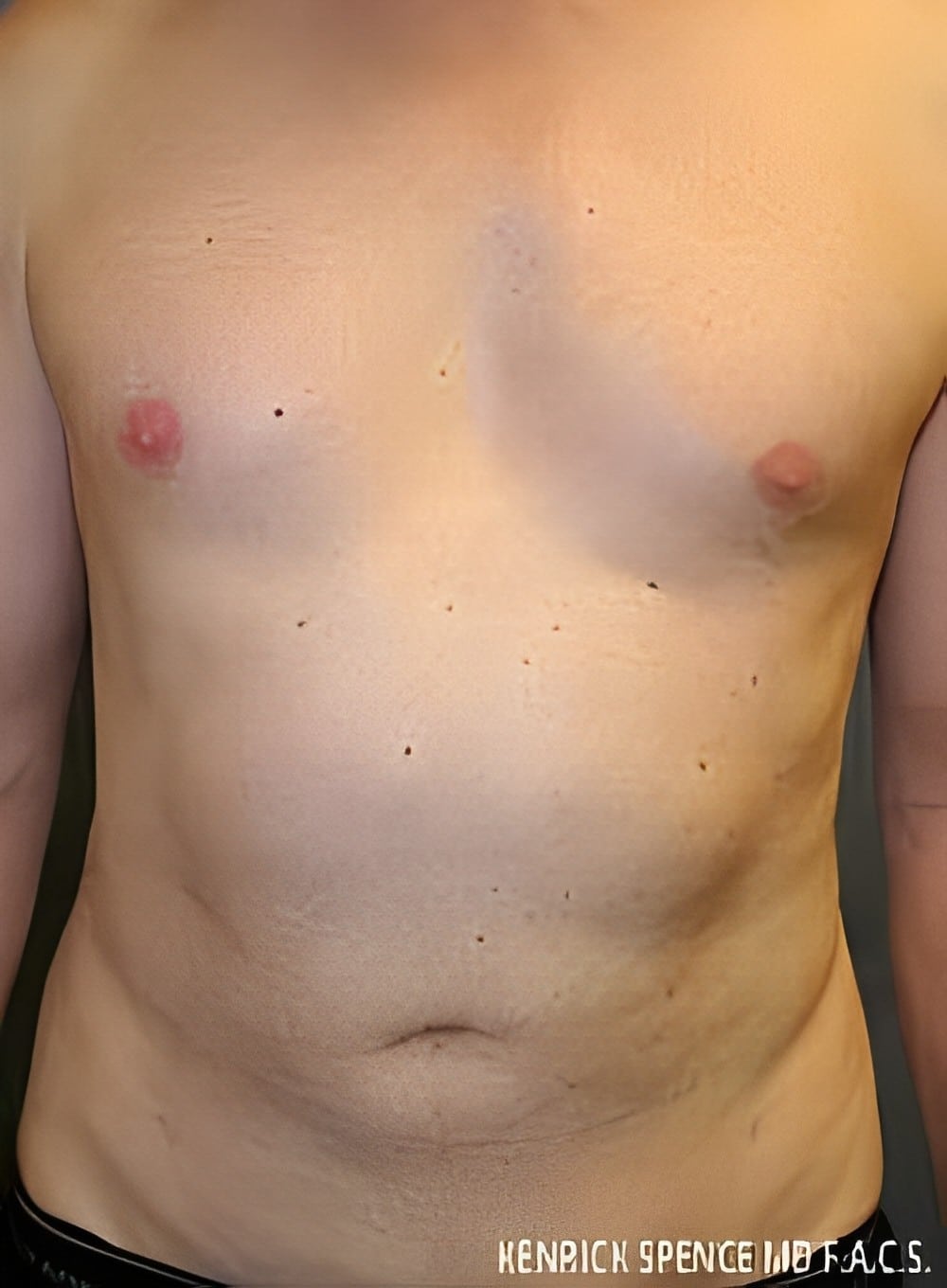 Before Image: SculptEase™ Liposuction-Dr. Kenrick Spence - front