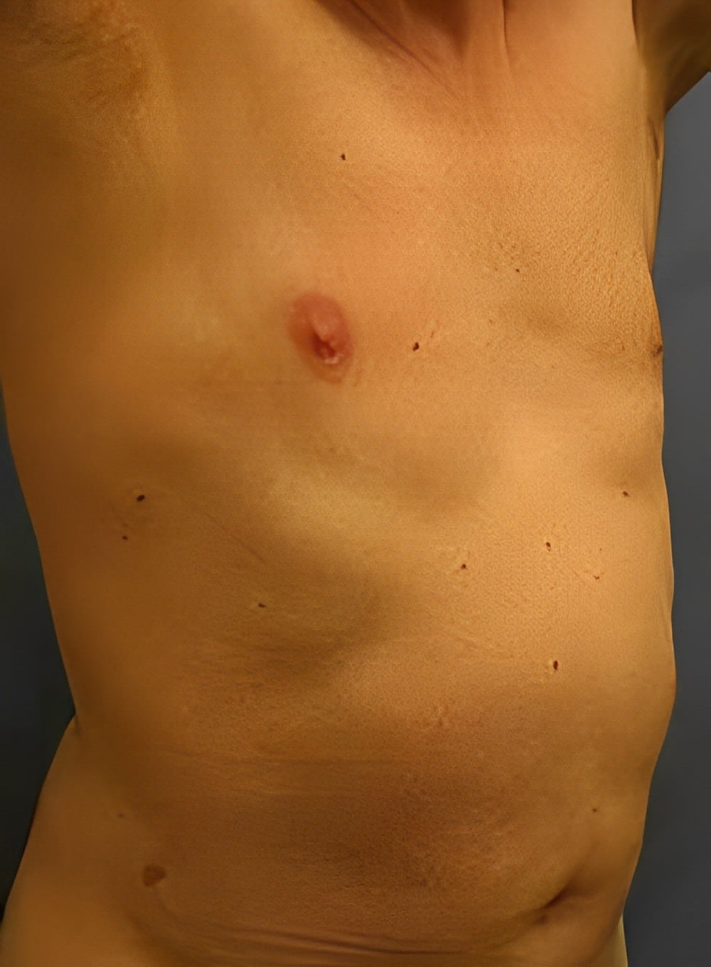 After Image: SculptEase™ Liposuction-Dr. Kenrick Spence - right-front-oblique
