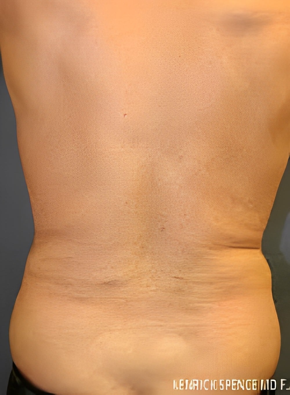 Before Image: SculptEase™ Liposuction-Dr. Kenrick Spence - back