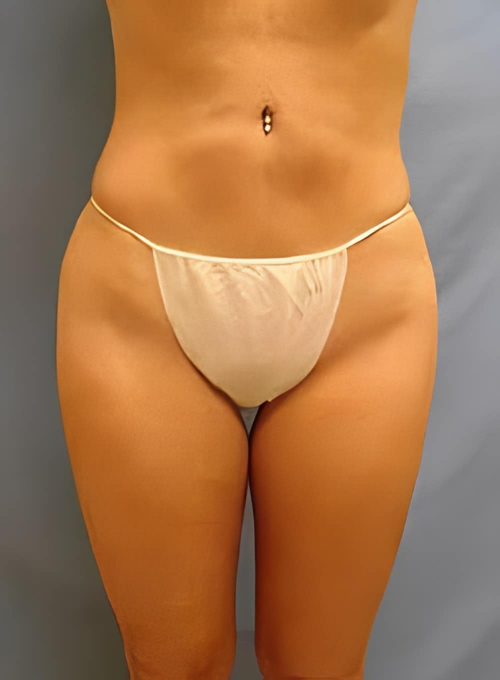 After Image: SculptEase™ Liposuction-Dr. Kenrick Spence - front