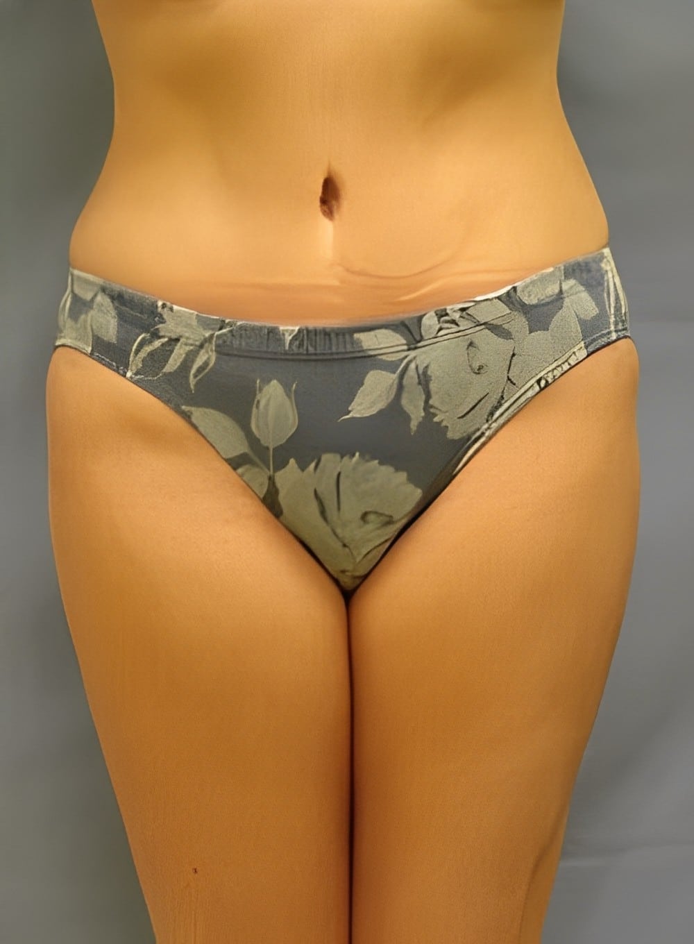 After Image: SculptEase™ Liposuction-Dr. Kenrick Spence - front