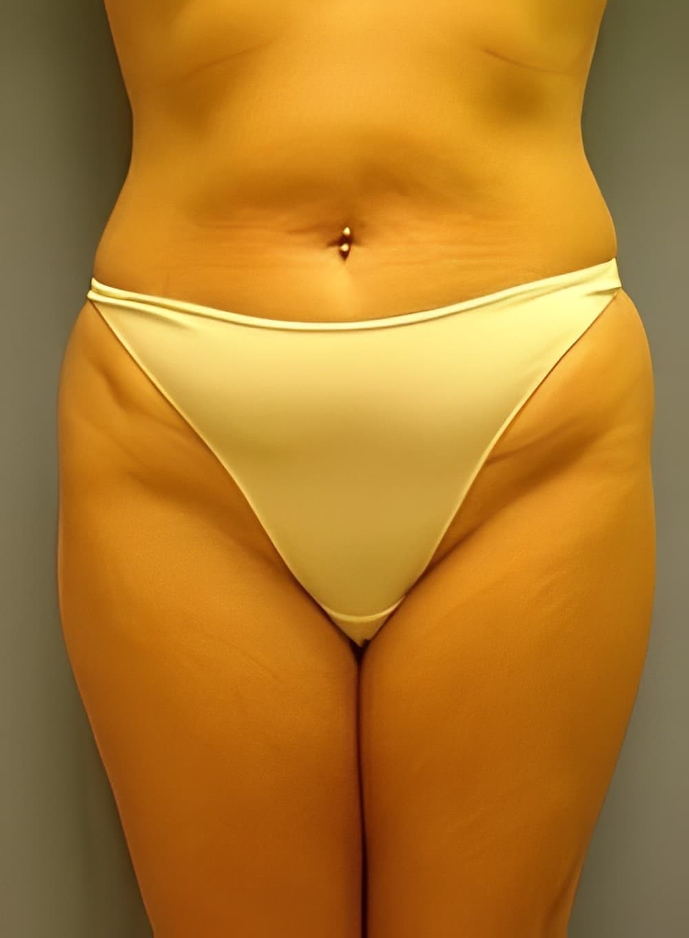 Before Image: SculptEase™ Liposuction-Dr. Kenrick Spence - front