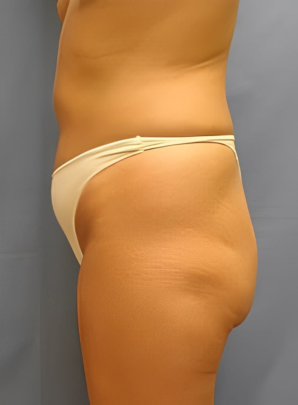 Before Image: SculptEase™ Liposuction-Dr. Kenrick Spence - left-side