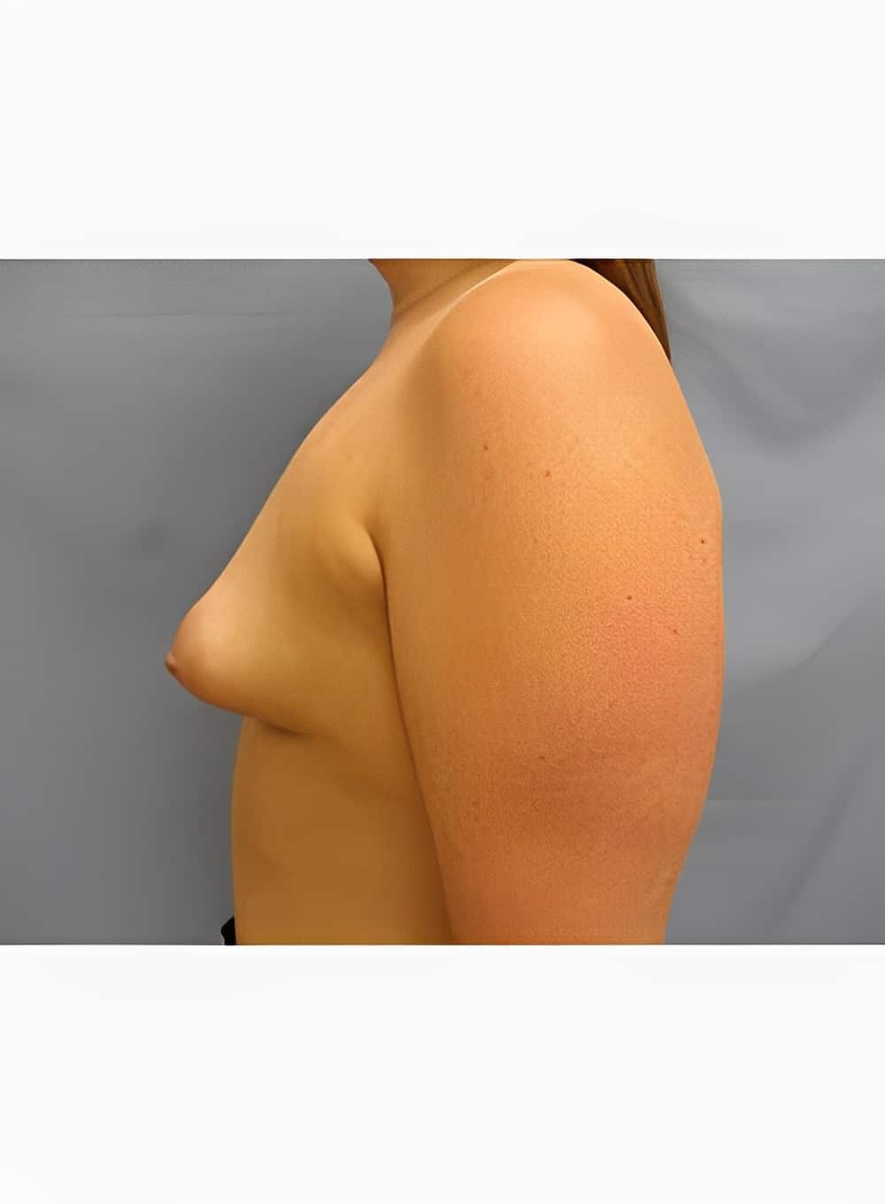 Before Image: Breast Augmentation-Dr. Kenrick Spence - left-side