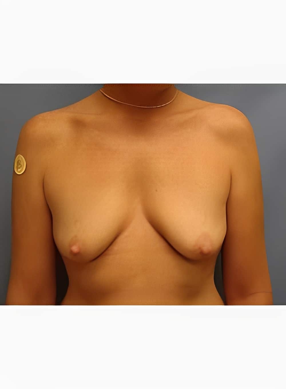 Before Image: Breast Augmentation-Dr. Kenrick Spence - front