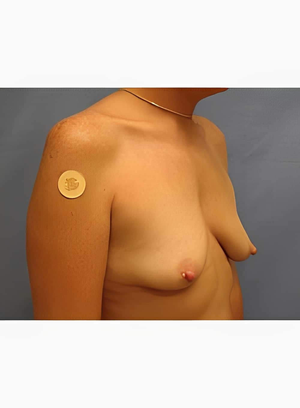 Before Image: Breast Augmentation-Dr. Kenrick Spence - right-front-oblique