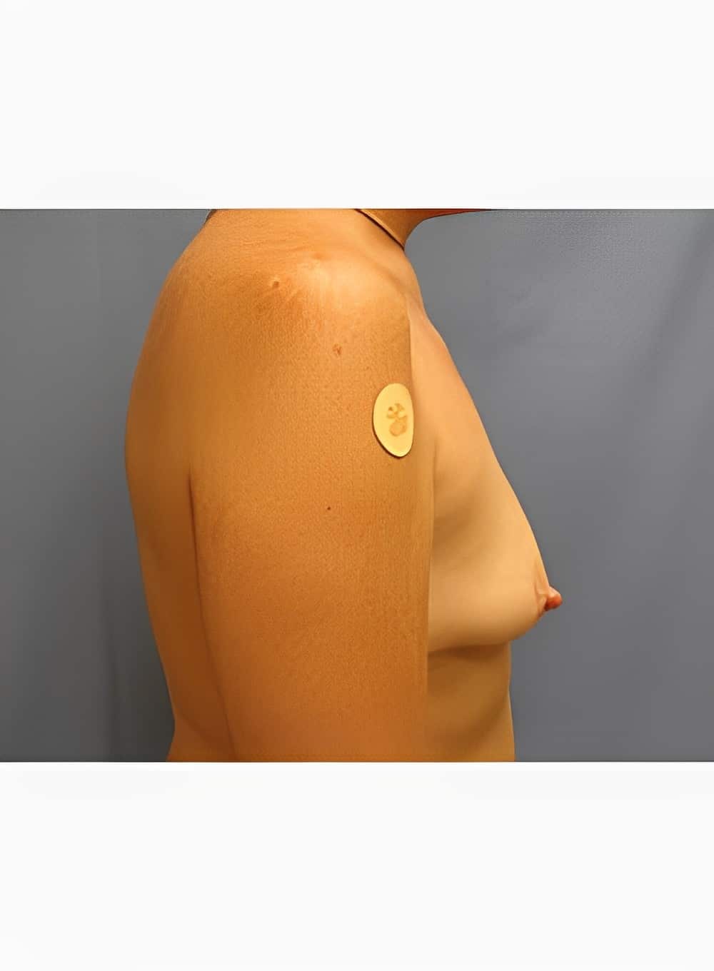 Before Image: Breast Augmentation-Dr. Kenrick Spence - right-side