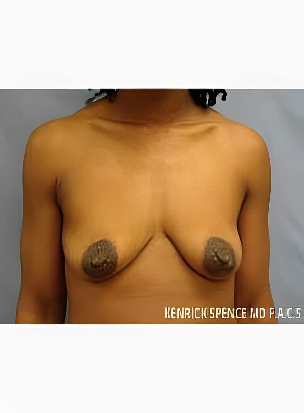Before Image: Breast Augmentation-Dr. Kenrick Spence - front